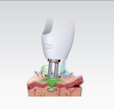 Laser Long Pulse Duallase Harmony, Alexandrit 755 nm și Nd:YAG 1064 nm - miniatură 4